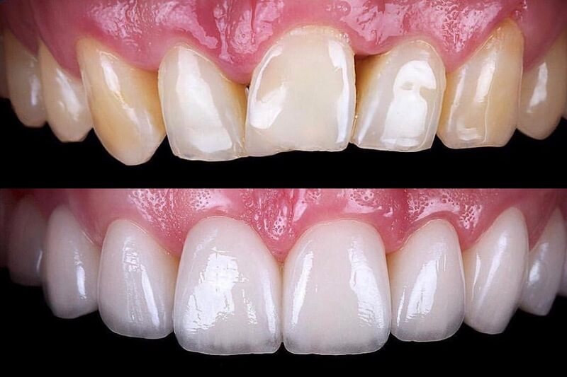 Two close-up views of front teeth showing differences in their appearance